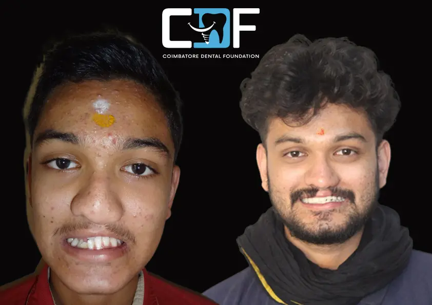 Braces Before After